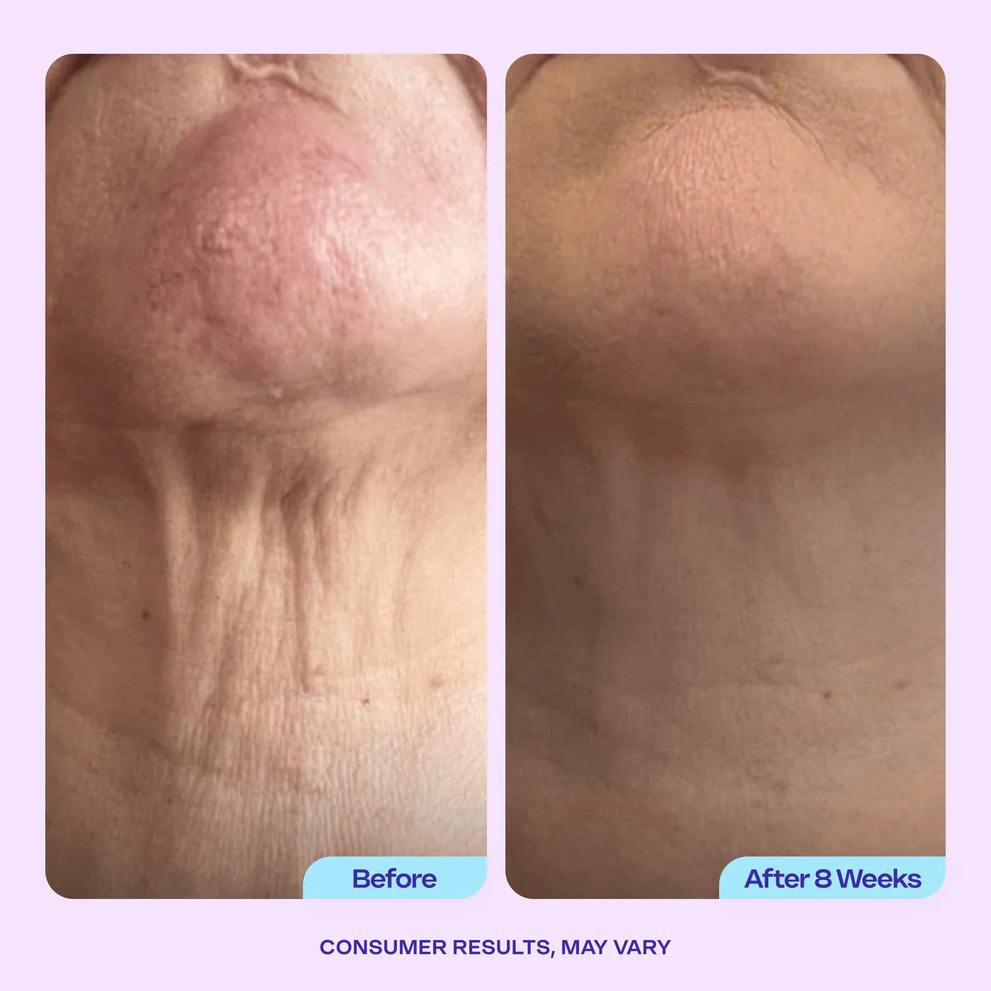 Pickerry™ Tighten & Lift Neck Cream